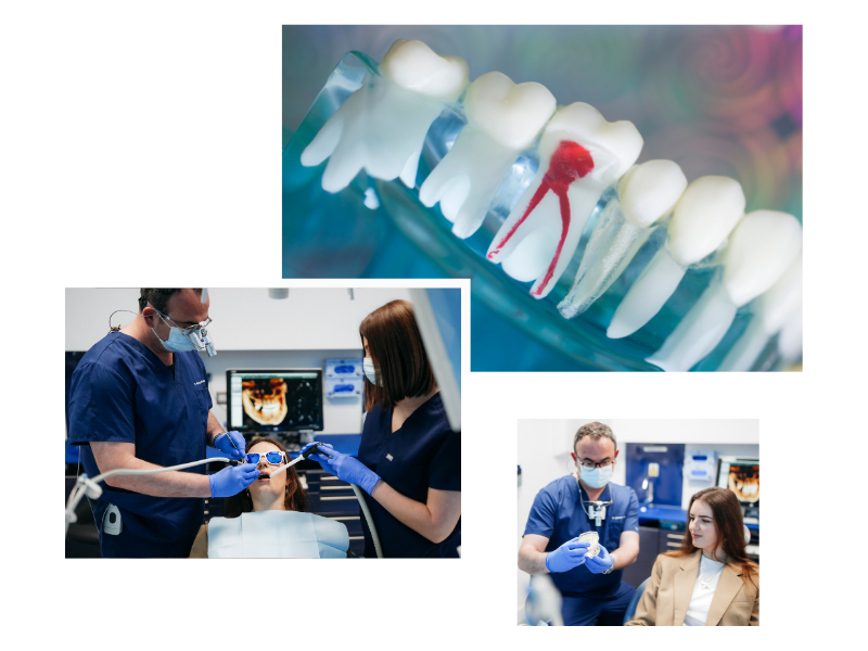 Root Canal Treatment in Swiss Cottage