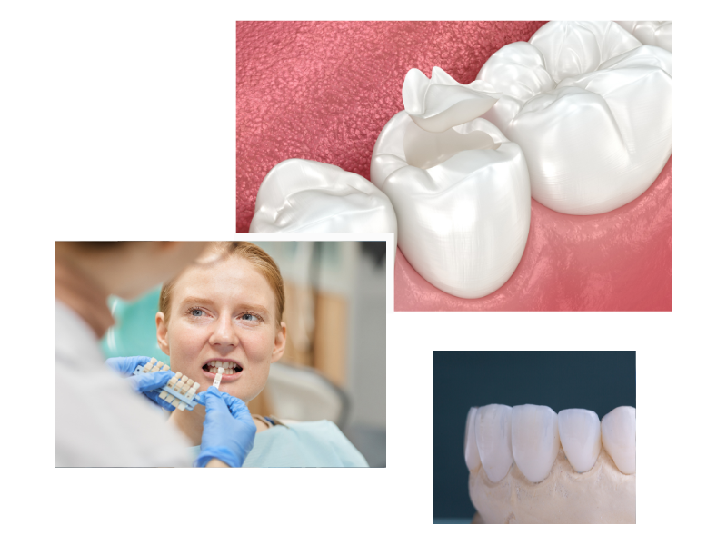 Dental Crowns in Swiss Cottage