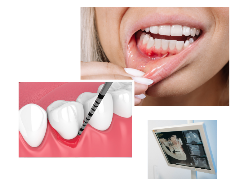 Gum Disease treatment in swiss cottage