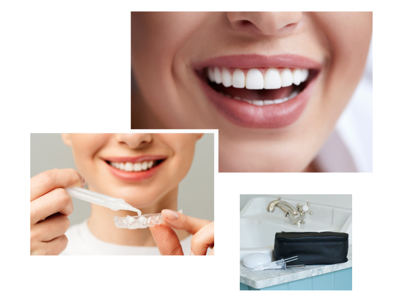 Teeth Whitening in Swiss Cottage