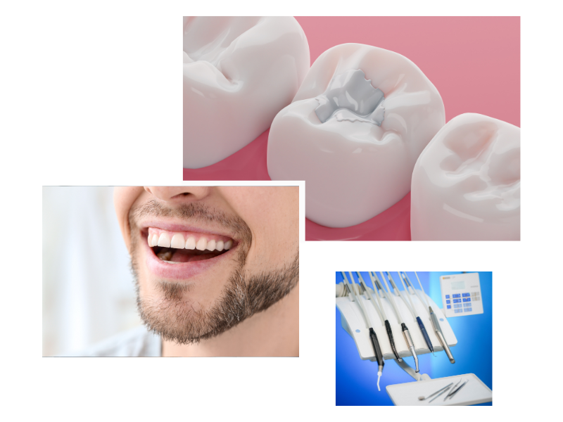 White fillings in swiss cottage